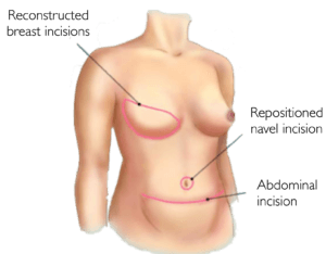 Stacked DIEP Flap Diagram