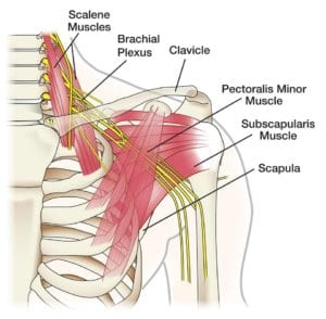 Brachial Plexus Injury Example